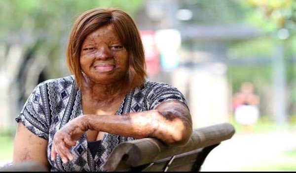 Plane crash survivor, Kechi Okwuchi undergoes surgery