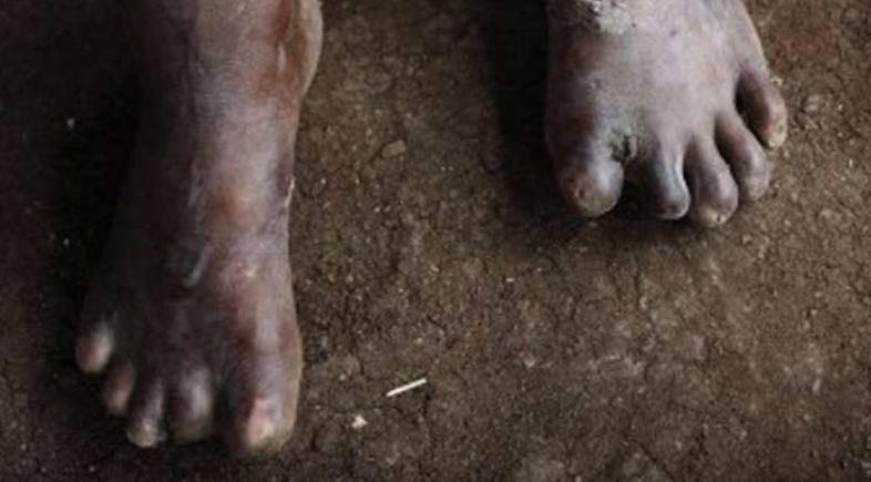 Gombe at risk of undetected leprosy cases – Expert