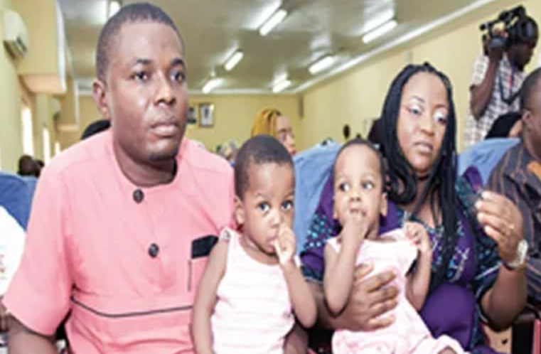 National Hospital separates co-joined twins