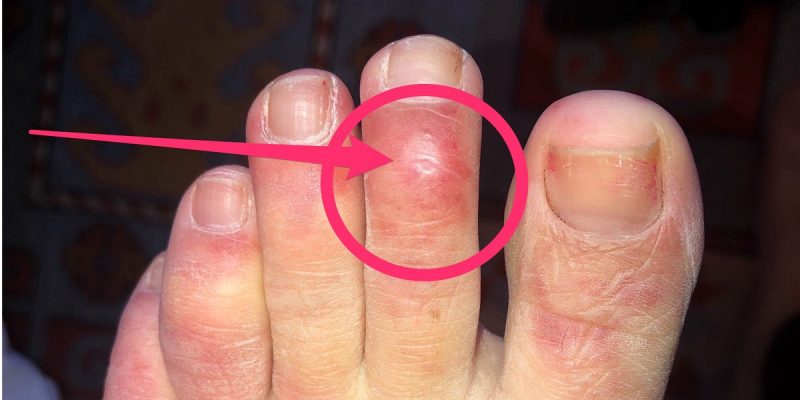 Doctors discover new COVID-19 symptom