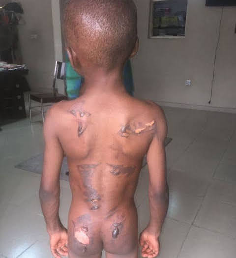Starving Nigerian boy scarred with hot iron by aunt over N50 groundnuts