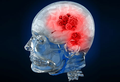 Israeli scientists discover way to block spread of brain cancer