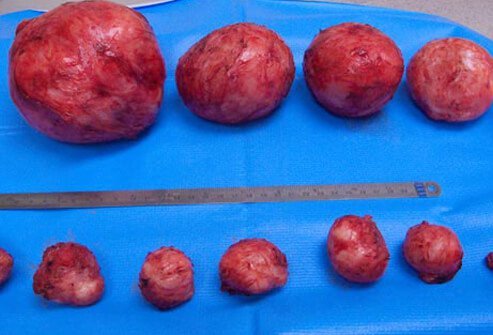 Health: Permanent solution to fibroid revealed