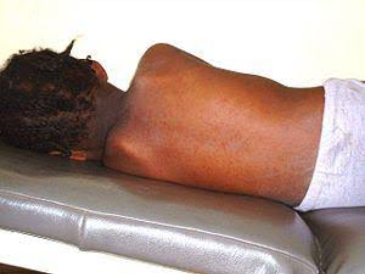 She died of measles - By Stephen Ojapah