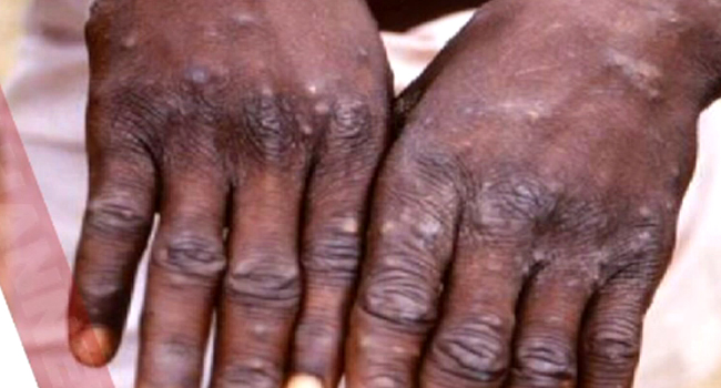 UNHCR: Suspected 40 mpox cases among Congolese refugees