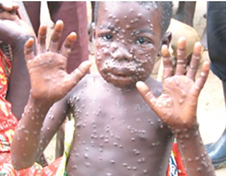 Mpox: EU to donate 215,000 doses of vaccines to Africa