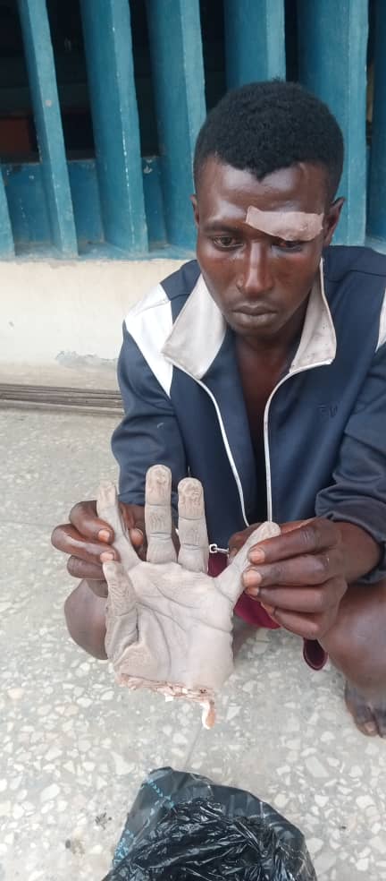 Love struggle turns bloody as 21-year-old sever rival’s hand