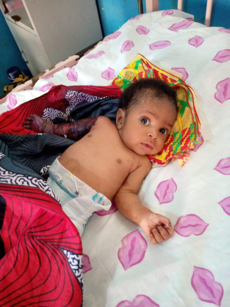 New photos of baby Miracle after his hand was amputated over his father's assault