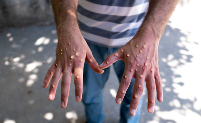 Mpox clade 1b transmission worries Lagos govt