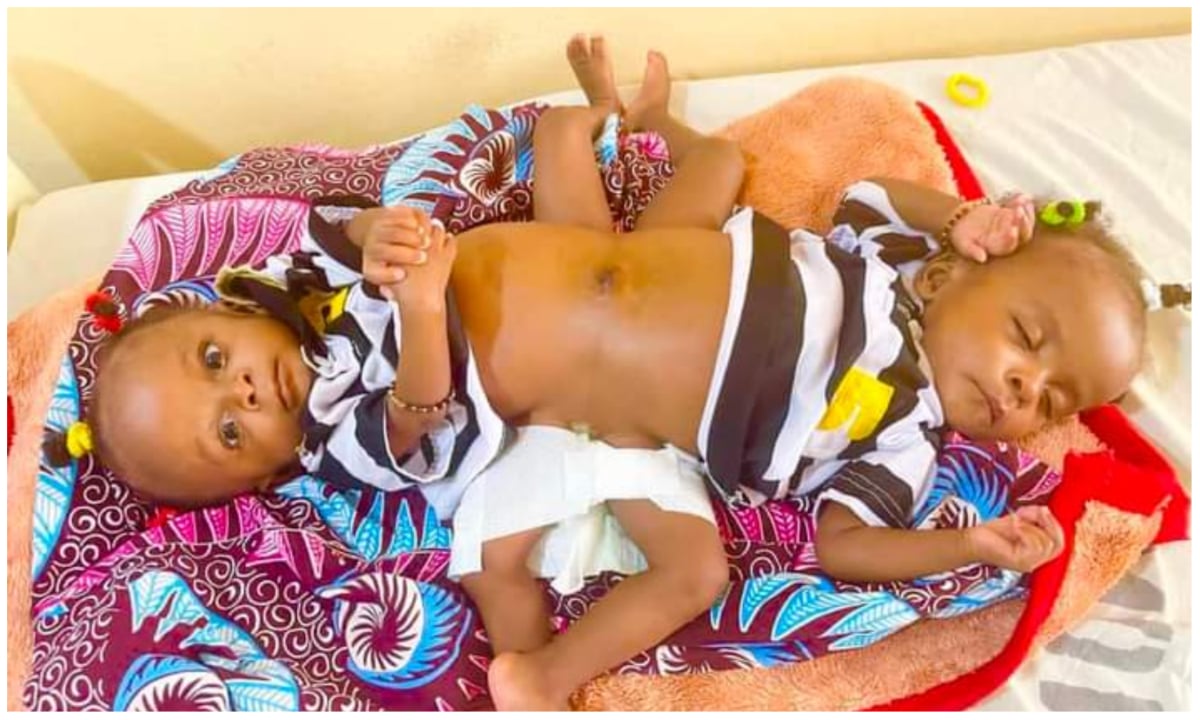 UAE hospital offers to seperate Nigerian conjoined twins for free