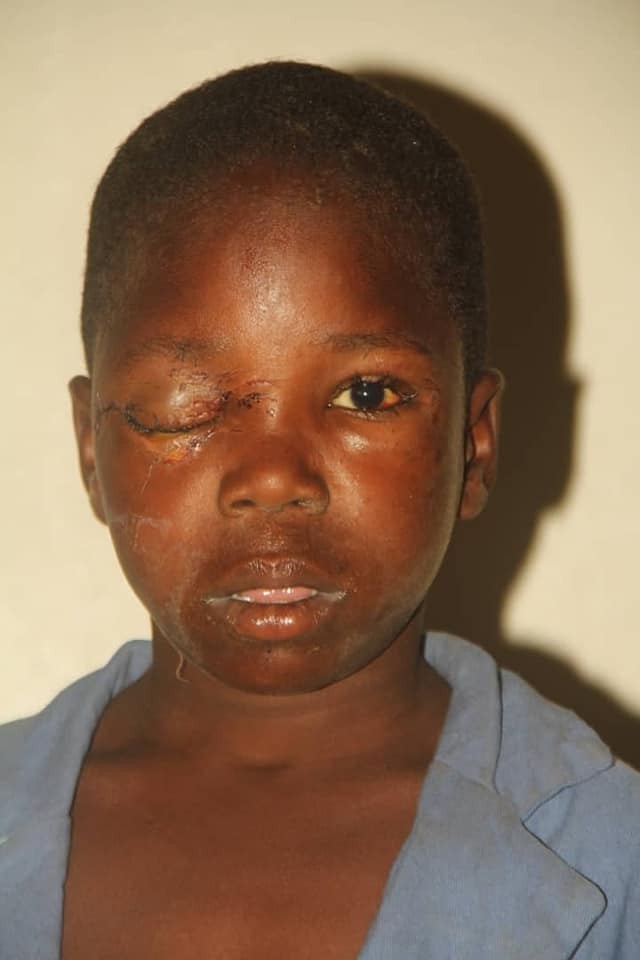 How suspected ritualists removed 12-year-old boy’s eye in Bauchi
