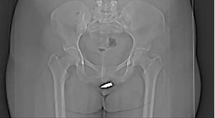 Breakthrough! Stray bullet removed from woman’s clitoris in unprecedented injury
