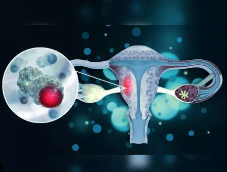 Why no woman should die from Cervical Cancer
