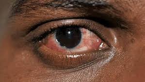 Schools closed in India amid rising cases of eye flu