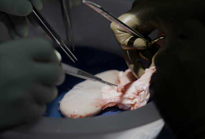 BREAKTHROUGH! 54-yr-old grandma receives first pig kidney transplant, mechanical heart