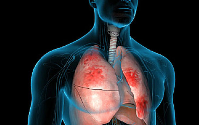 Rainy season myth on pneumonia busted