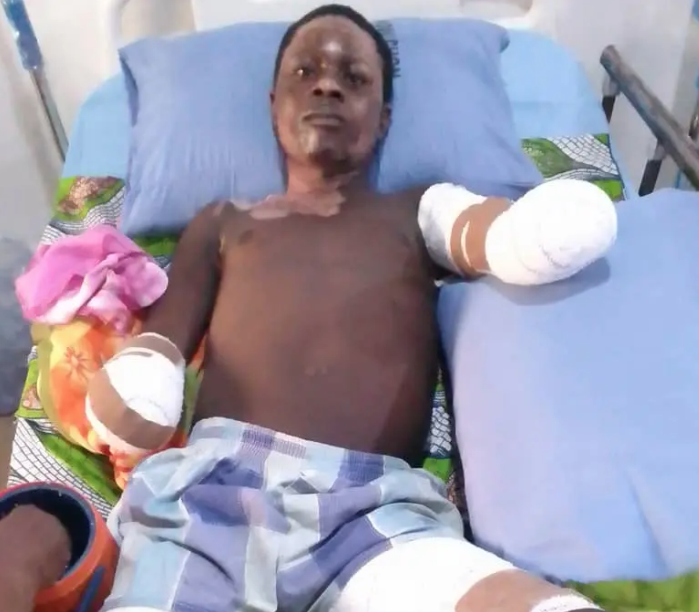 Nigerian student loses both hands while hoisting PDP flag in Taraba